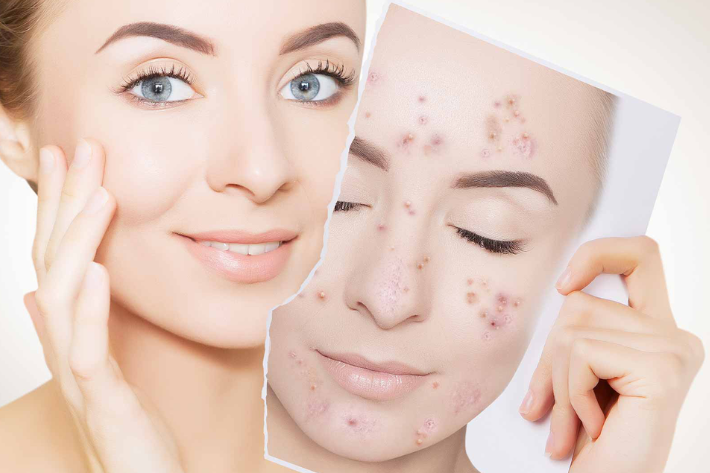 How Acne Creams Help Prevent Scars and Heal Your Skin